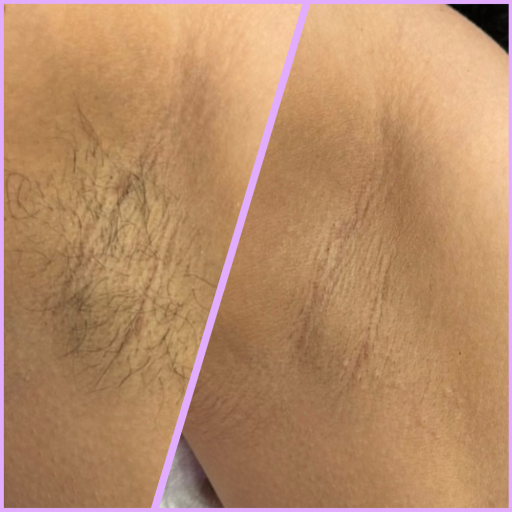 .⋆𐙚 Underarm Wax 𐙚⋆. at Euphoric Esthetics in Port Arthur, TX