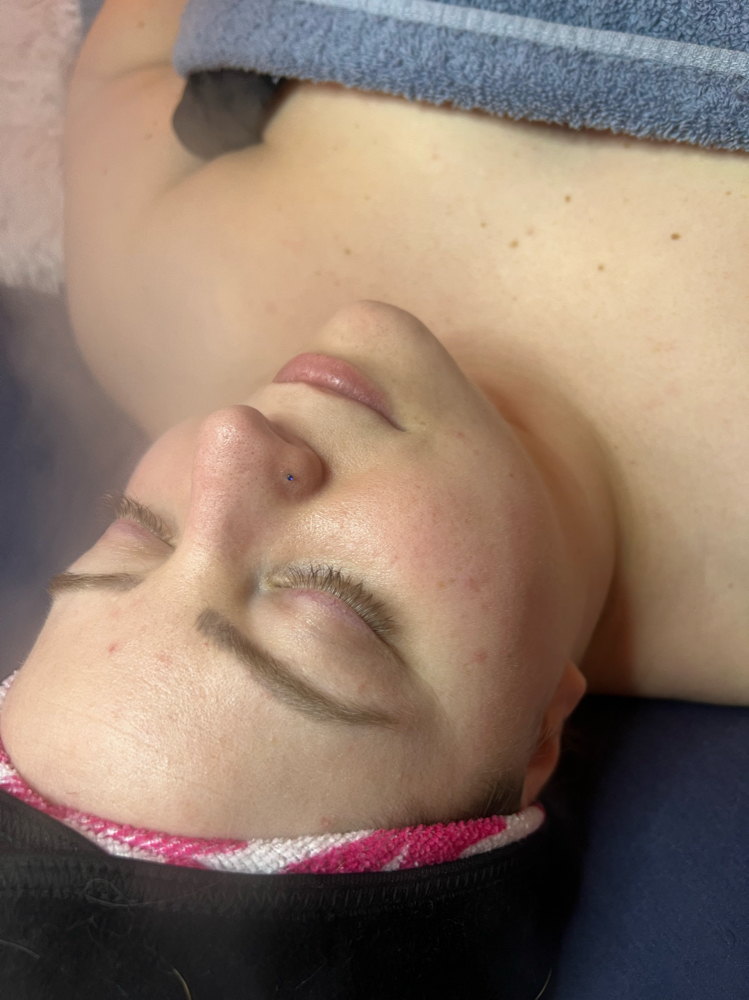 Facial Extractions