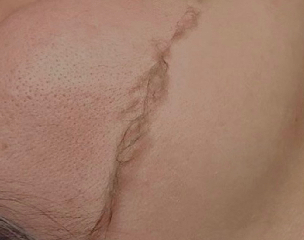 Dermaplaning Facial