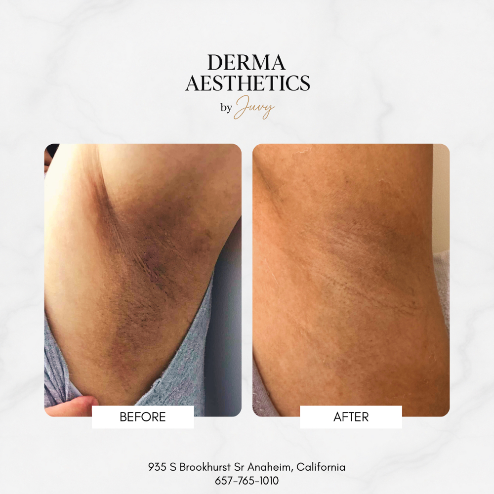 Underarm Brightening at Derma Aesthetics by Juvy in Brea, CA