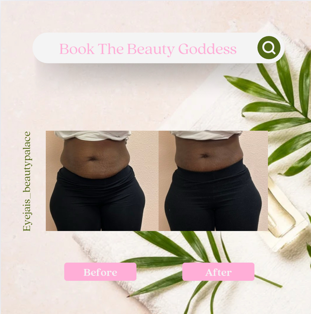 Skin Tightening