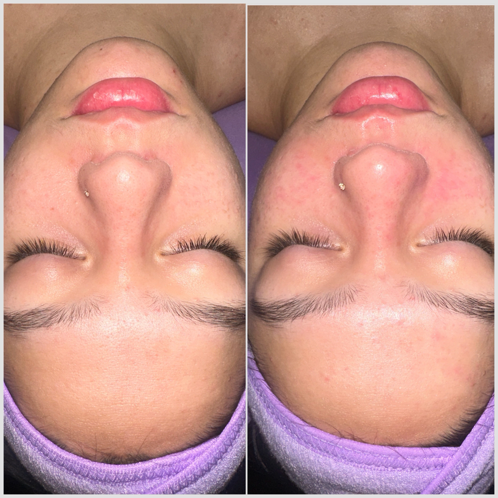 Chemical Peel Treatment