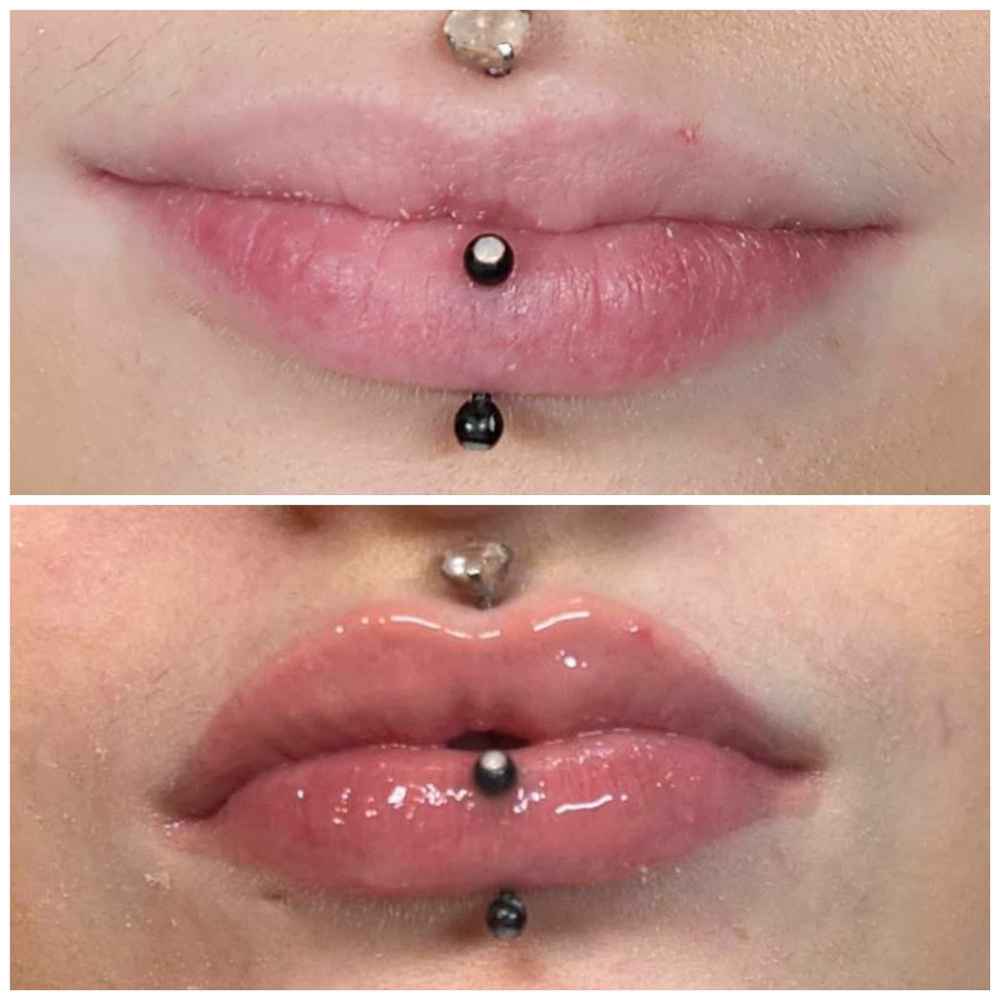 Hyaluron Lip Filler 1Ml