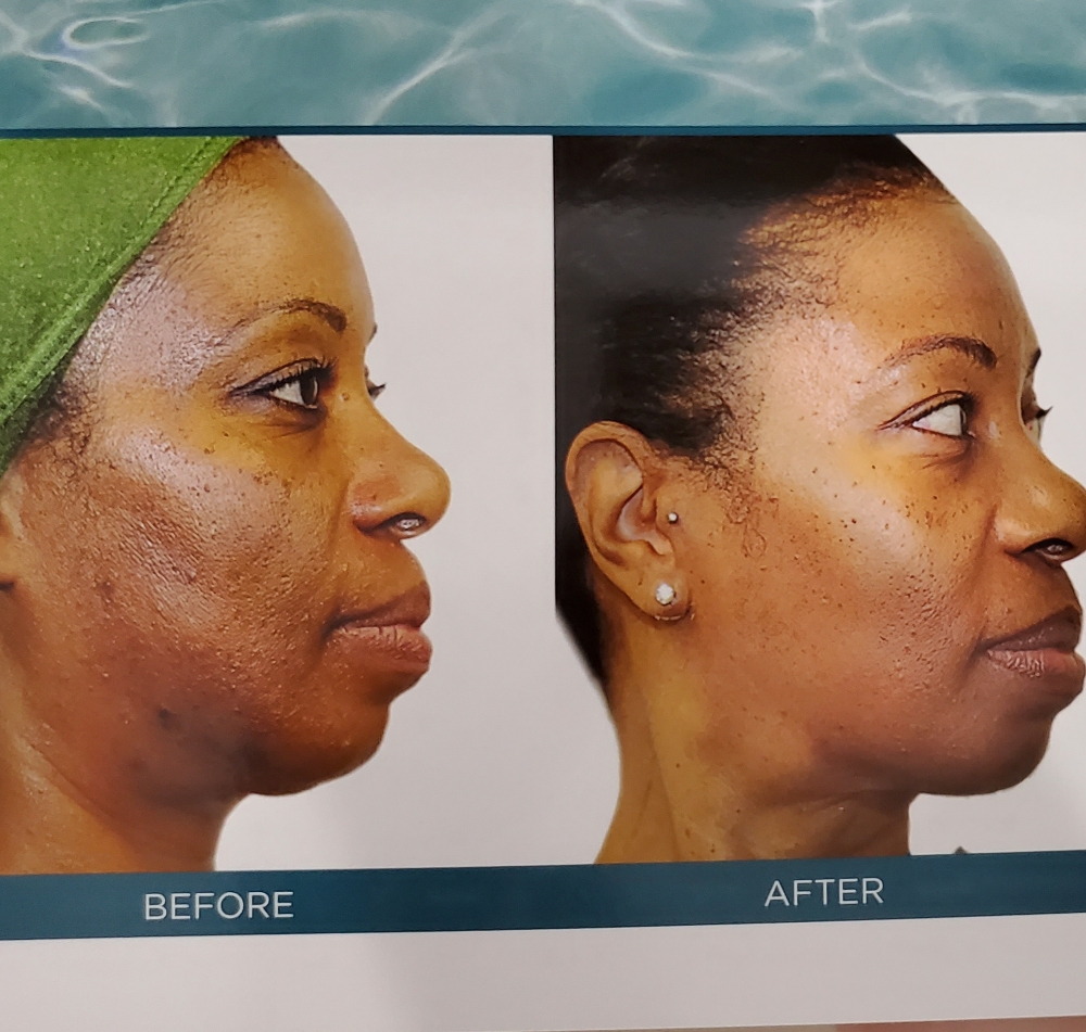 VIPeel And BODY Peel