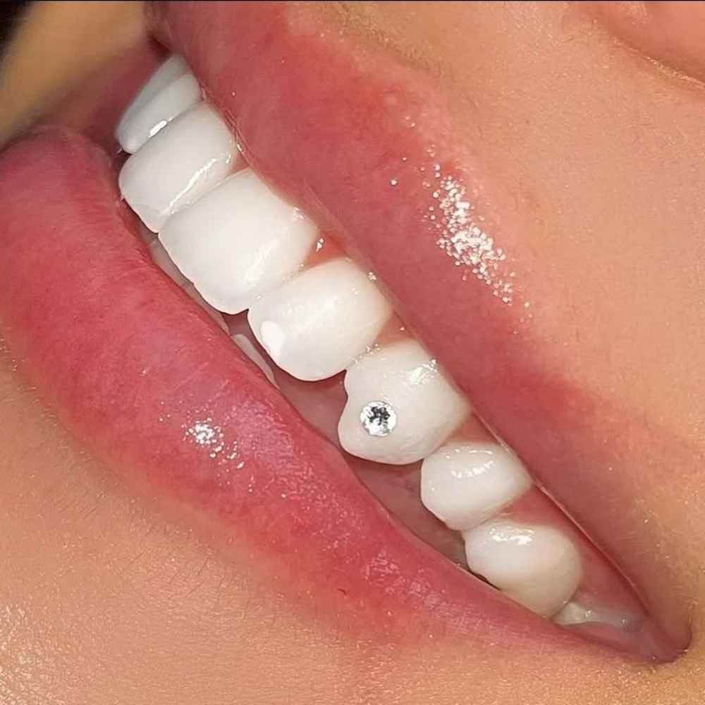 1 Round Tooth Gem at Teeth Whitening Lounge in Santa Ana, CA