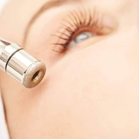 Microdermabrasion