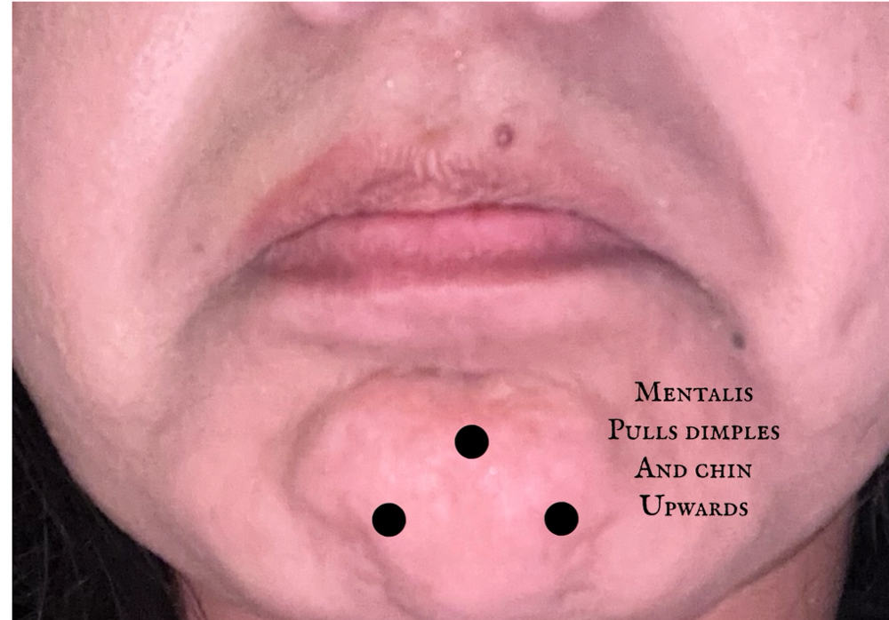 Mentalis - DIMPLED CHIN - Xeomin