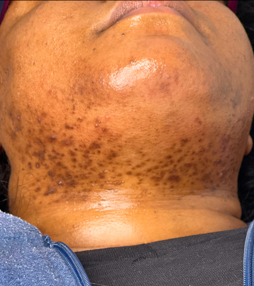 Chin Wax