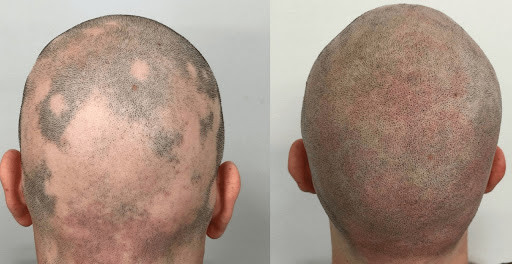 Scalp Micropigmentation