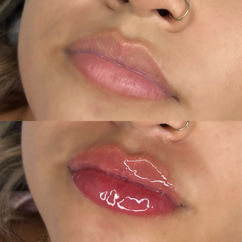 1ML New Client (HA) Lip Filler