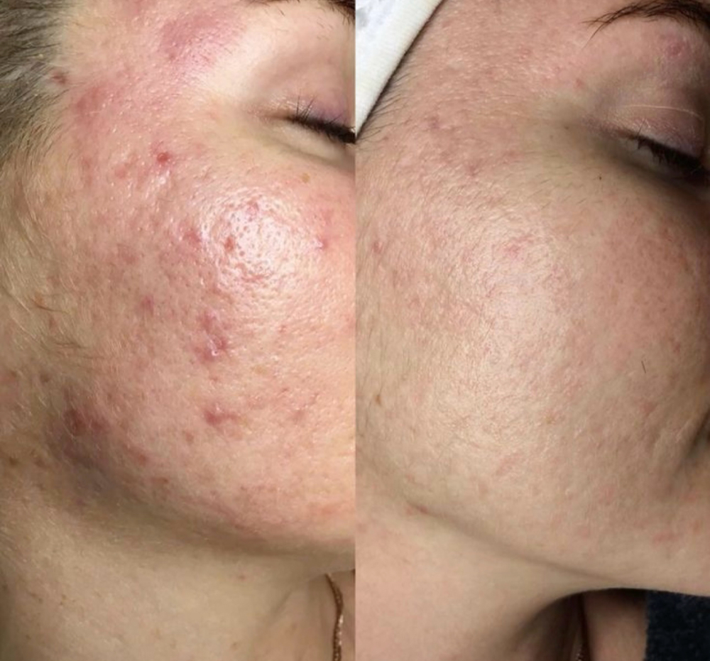 Clear Skin Acne Facial