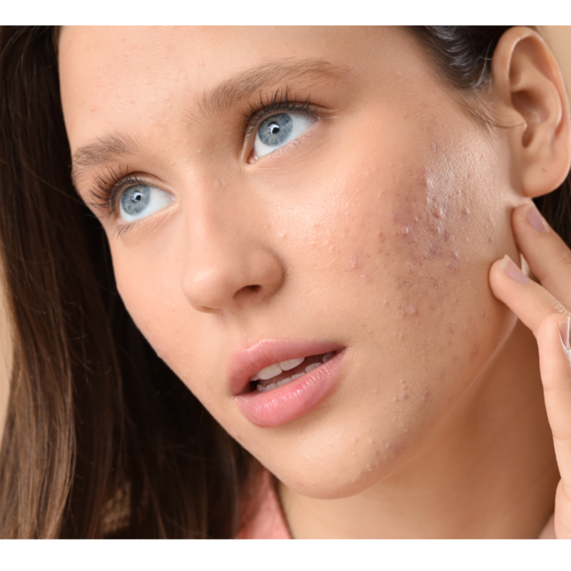 Acne Treatment at Rei’A Esthetics in Yonkers, NY