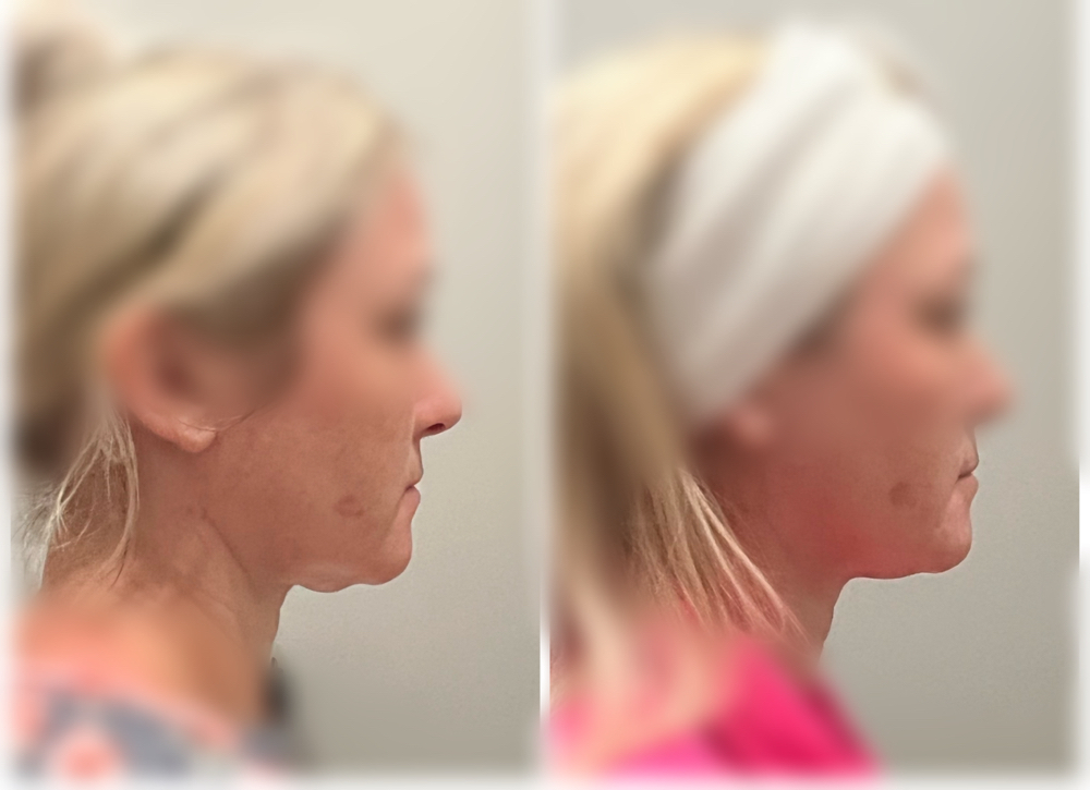 Skin Tightening Neck/Chin