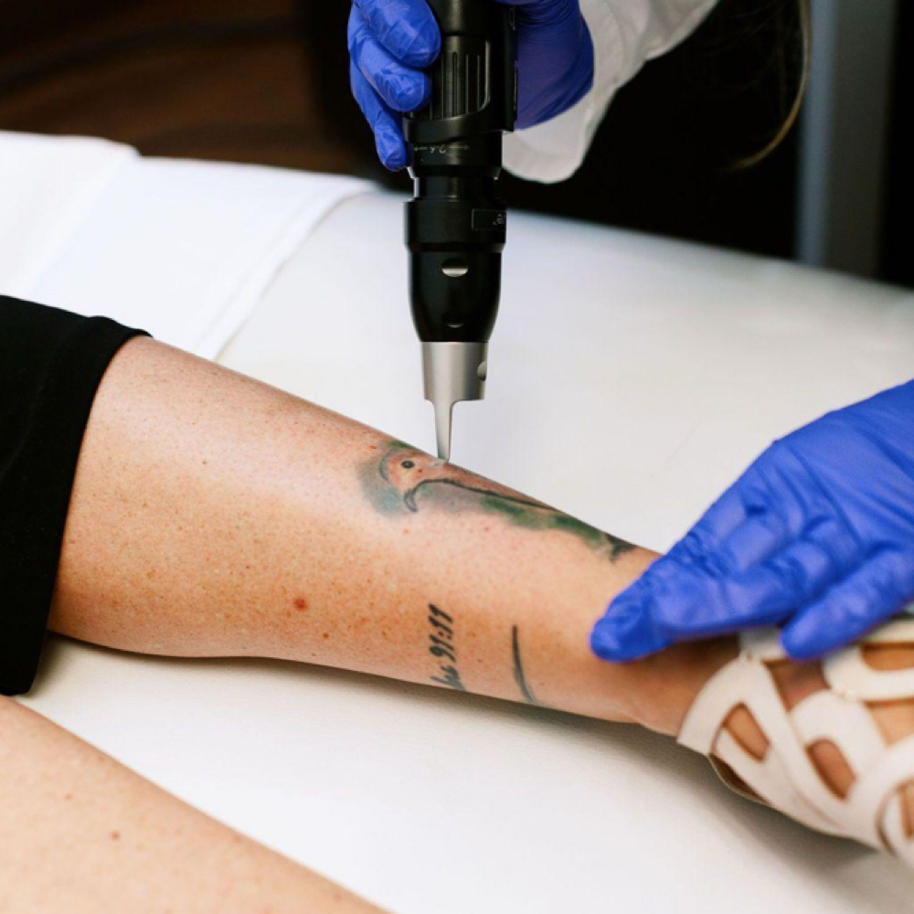 ✨Laser Tattoo Removal(5-7inch L)✨ at Nena’s Beauty Glow Bar in North Las Vegas, NV