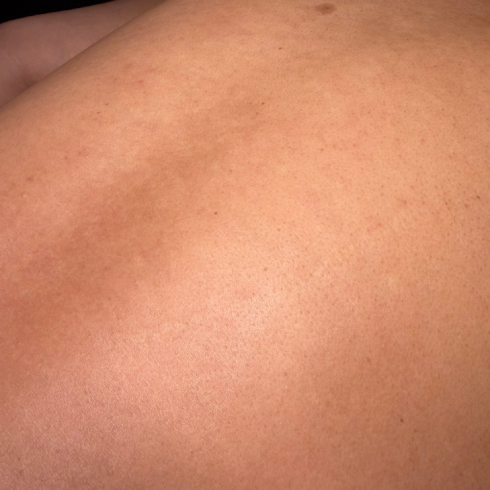 Clear + Smooth Back Facial at Esthaelis Skin in Riverside, CA