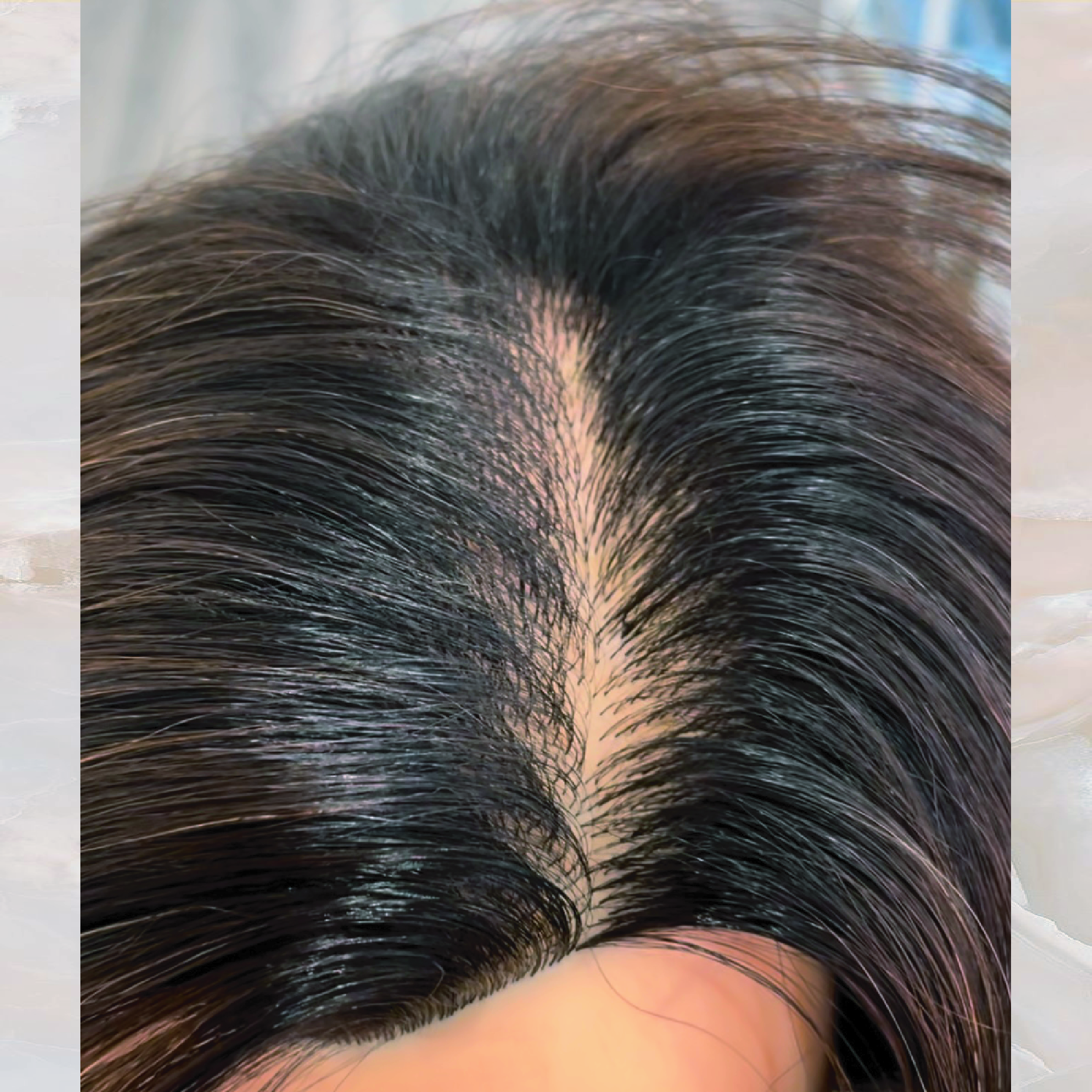 Partial Root Touch-Up