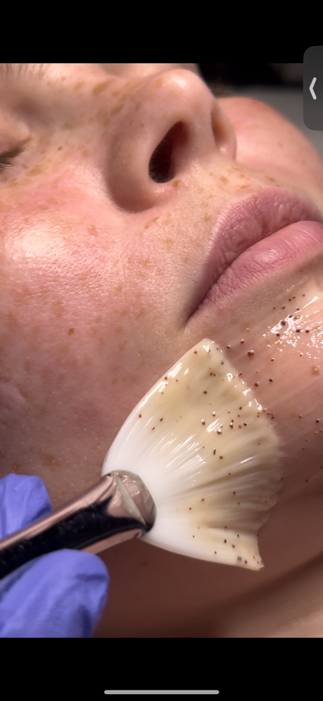 Hybrid Peel Facial
