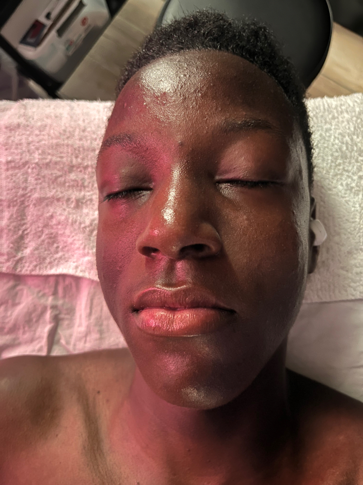 Teenage Anti-Acne facial