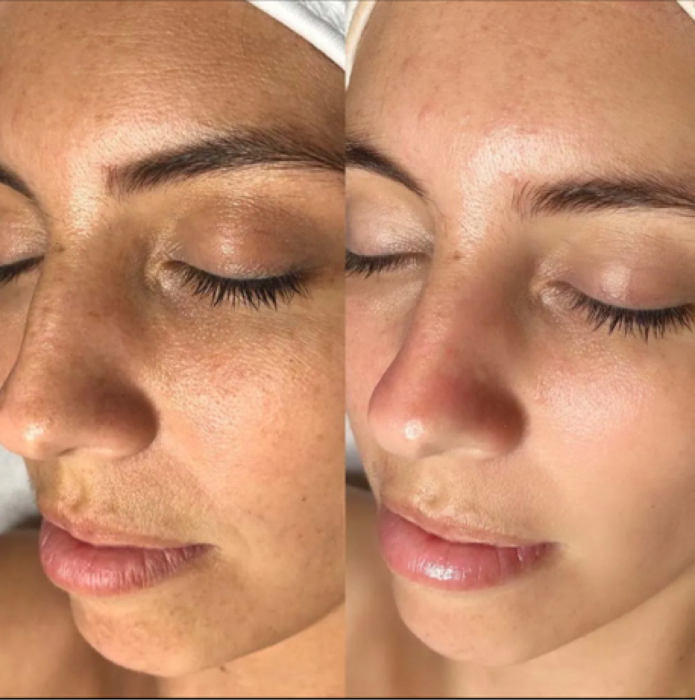 Oxygen Infusion Add-On