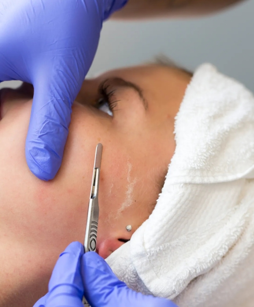 DERMAPLANING: SPECIAL PRICING