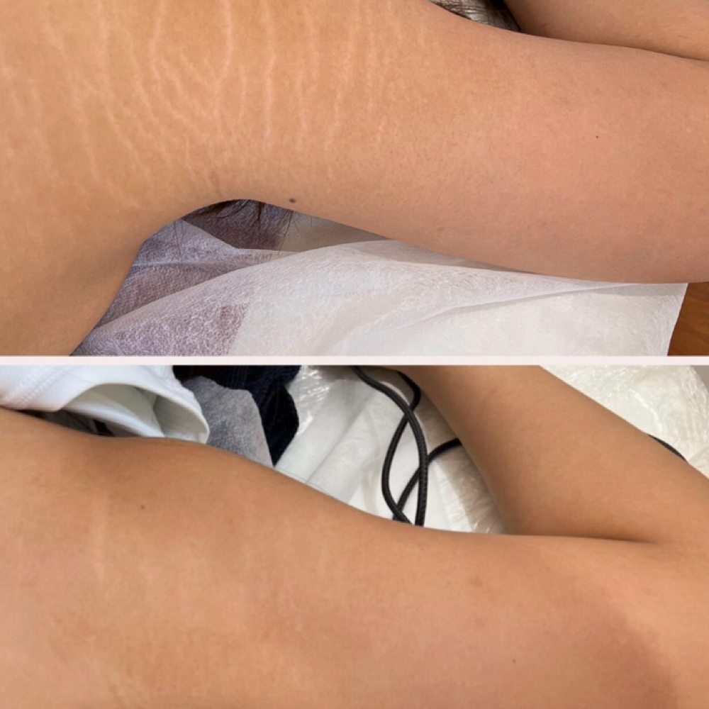 Stretch Mark Camo | Large Area at Skin Theory Collective in Port Richey, FL