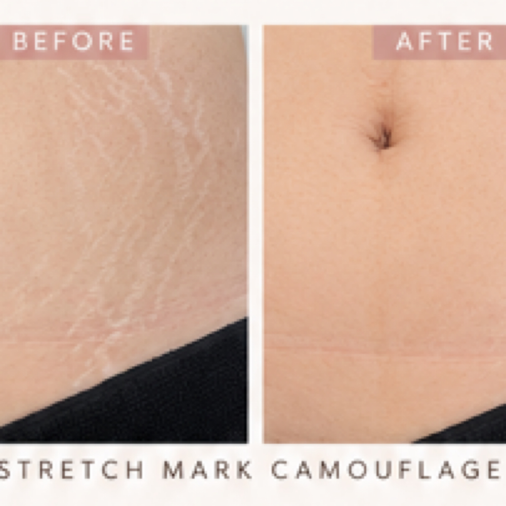 Stretch Mark Camo | Large Area at Skin Theory Collective in Port Richey, FL