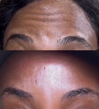 BOTOX INJECTIONS at Juiced by Q in Baldwin, NY