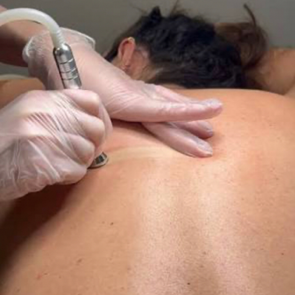 Microdermabrasion Back Facial at Forever Amor Massage & Spa By Aneashia in Monroe, LA