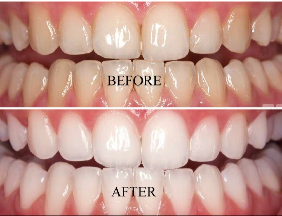 Teeth WHITENING