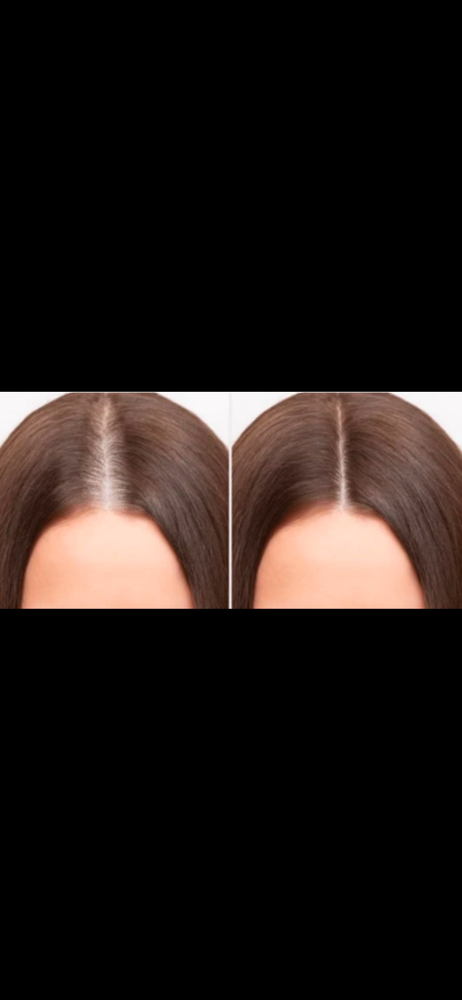 Hair growth stimulation & revision