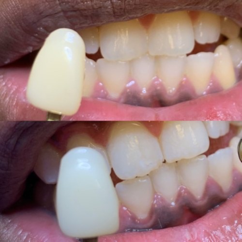 TEETH WHITENING SERVICE at Xclusive Beauty N' Brows in Houston, TX