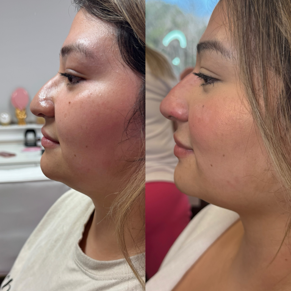 Liquid Rhinoplasty at IVitality in Pearland, TX