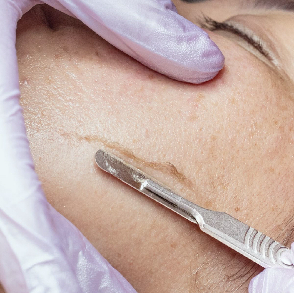 DermaPlane Facial at Skin Solutions by Aubrey in Owensboro, KY