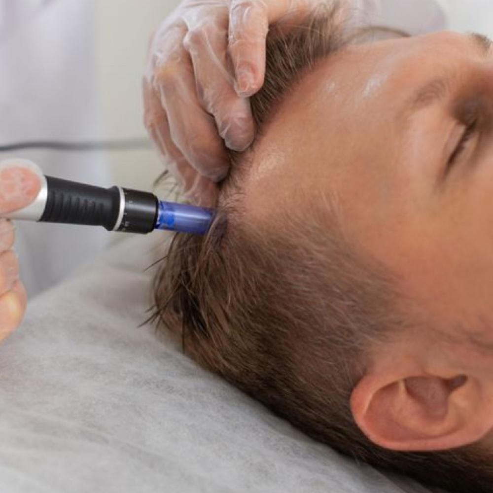 Microneedling Scalp Add-on at Vibe Skin Lab in Woburn, MA