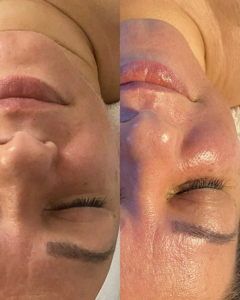 Anti-Aging Facial