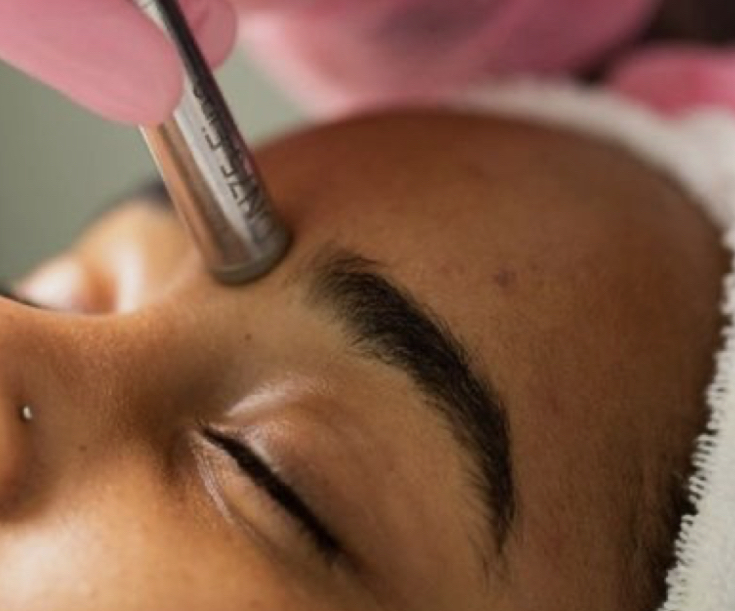 Microdermabrasion with Peel