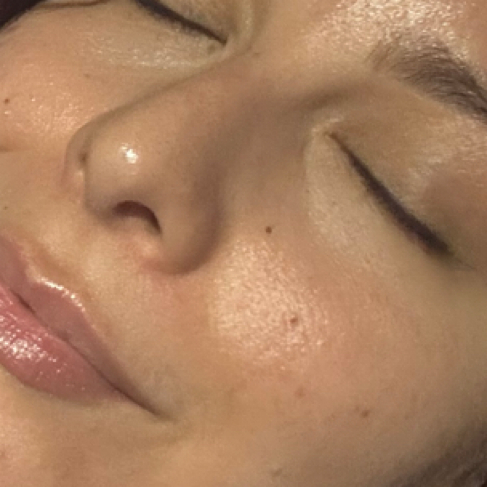 Microchanneling at Red Moon Esthetics in Orlando, FL