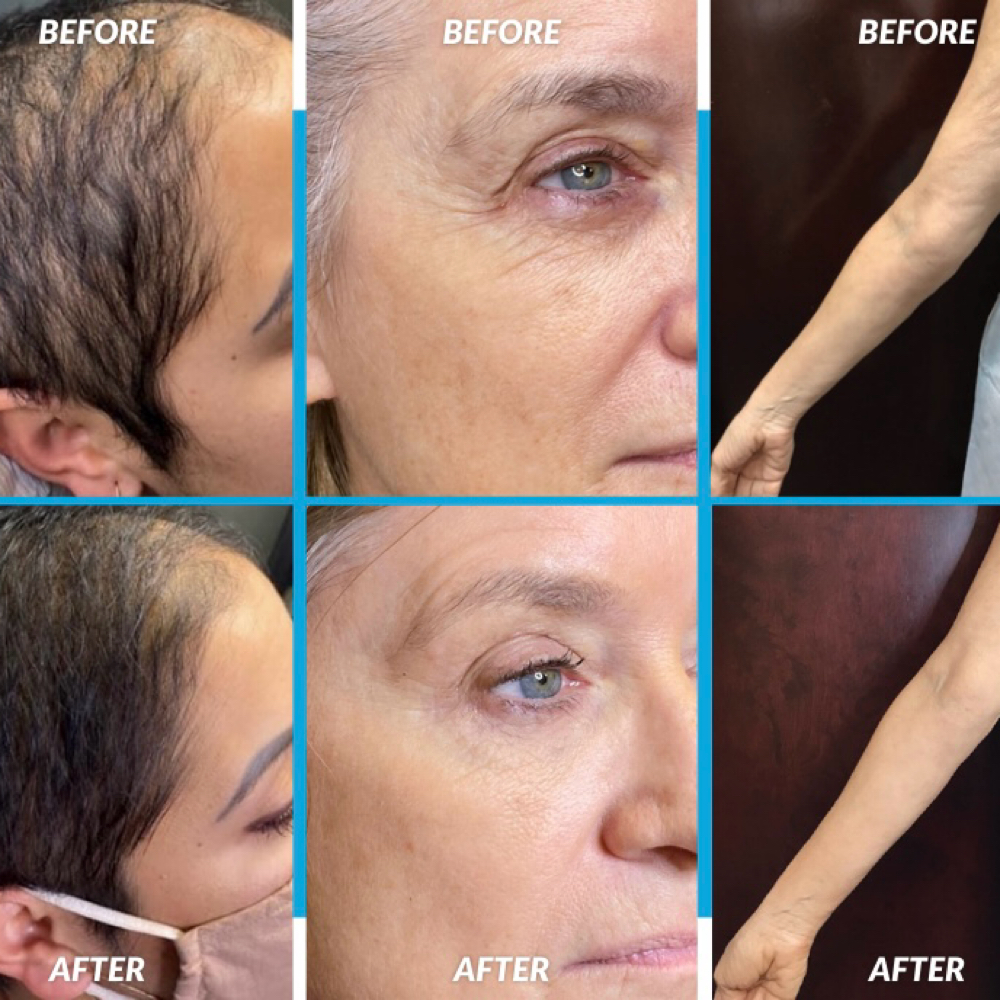 Microchanneling at Red Moon Esthetics in Orlando, FL