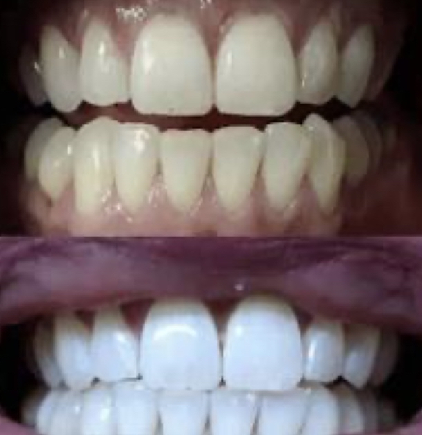 Teeth Whitening - 40 Minute Session