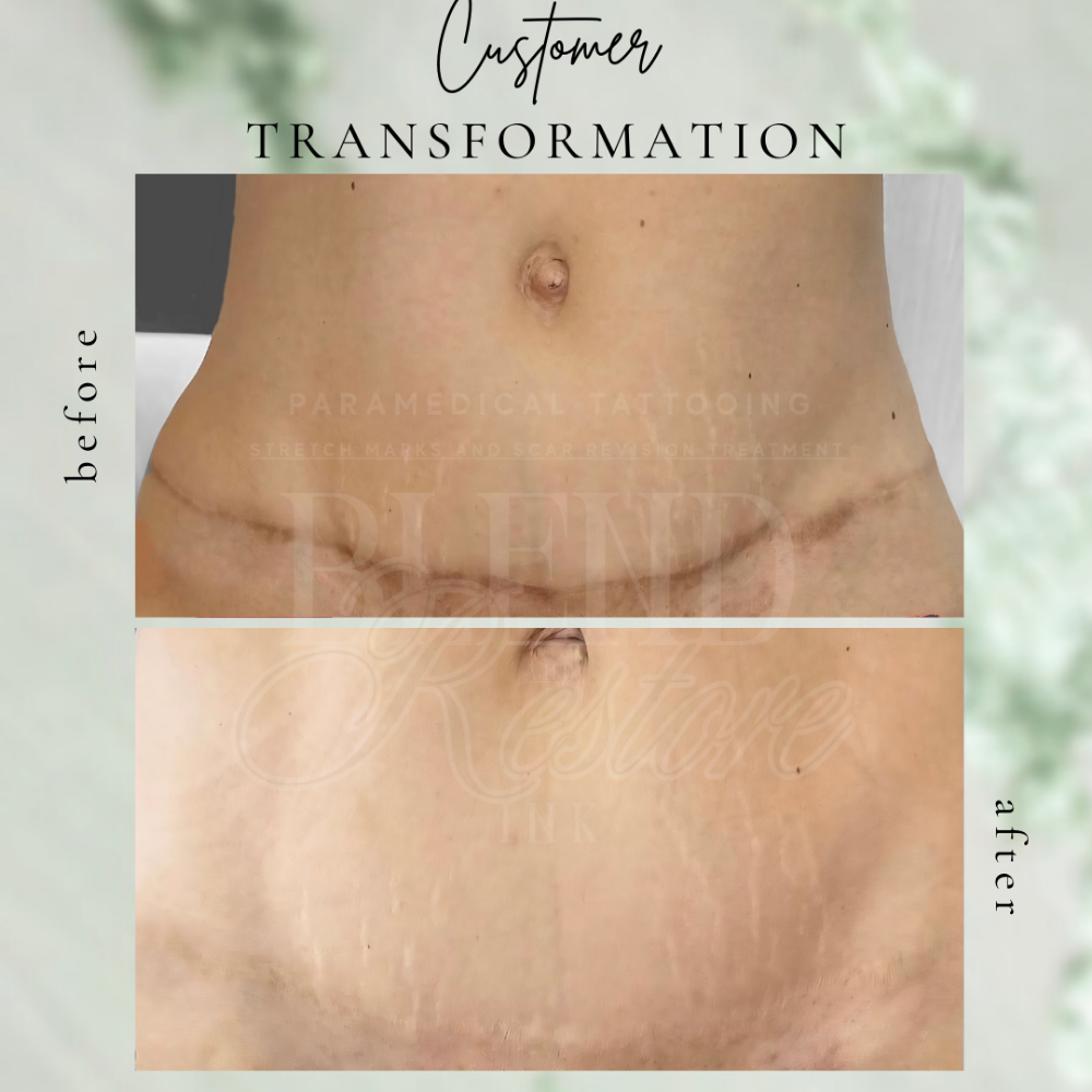 Tummy Tuck 180°