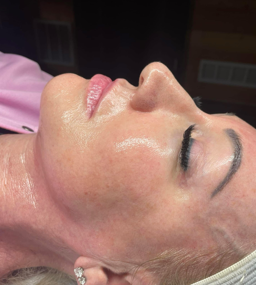 Dermaplane Facial