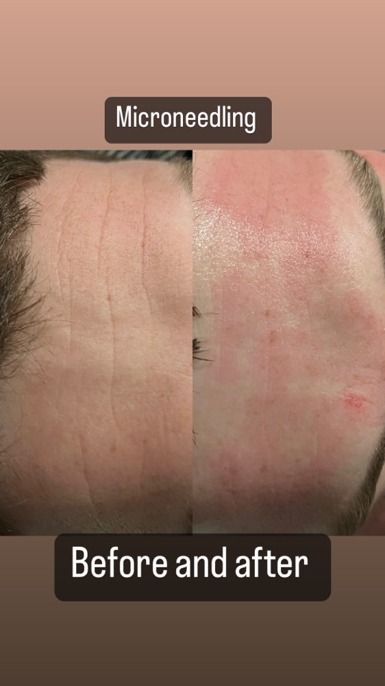 Microneedling