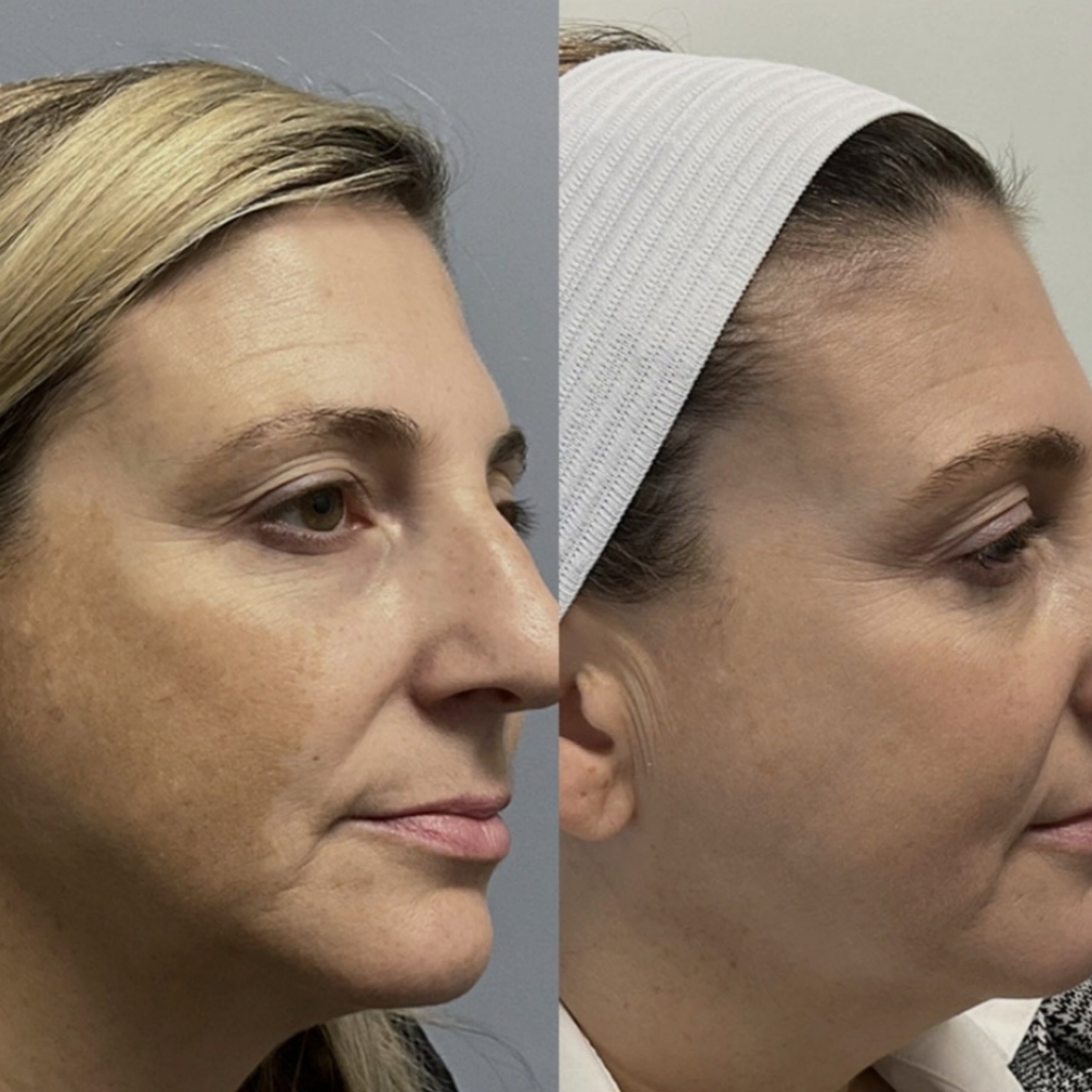 French Lumilight Peel