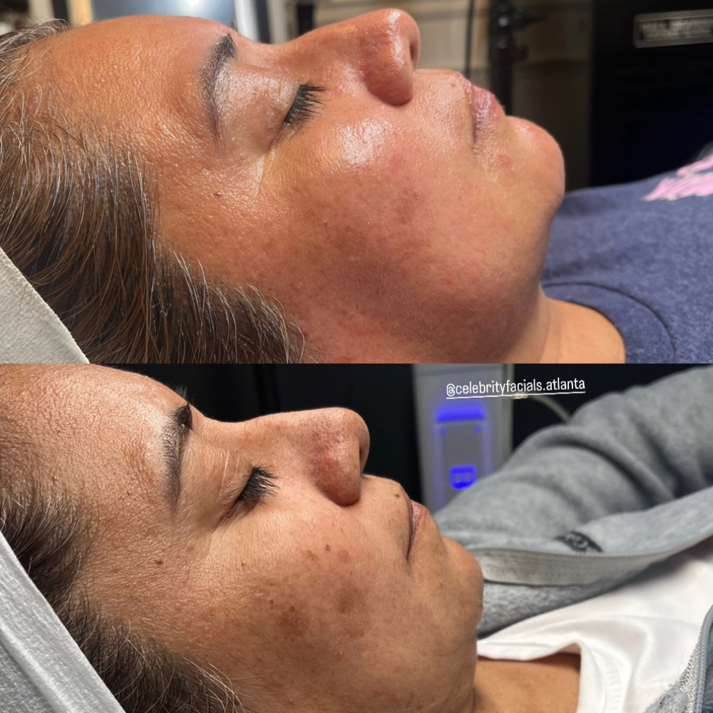 Returning client Celebrity Facial at Celebrity Facials LLC in Smyrna, GA