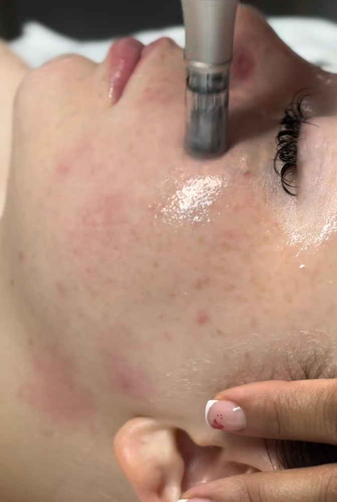 Facial with Nano-Infusion