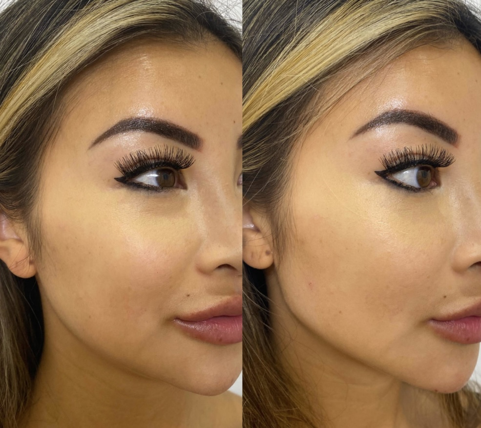 Jaw Line Filler