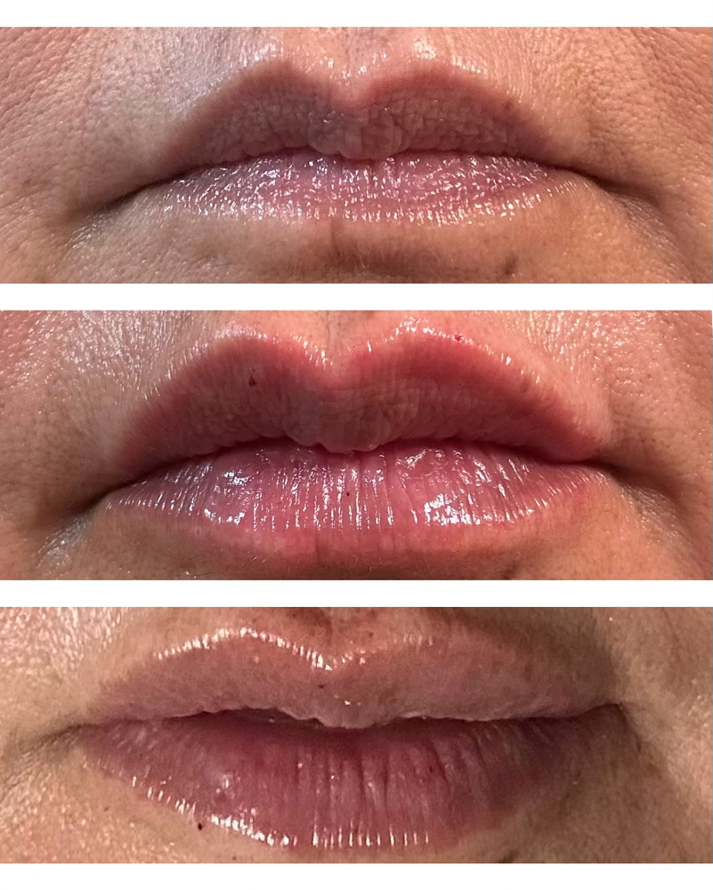 Mini Lip Enhancement
