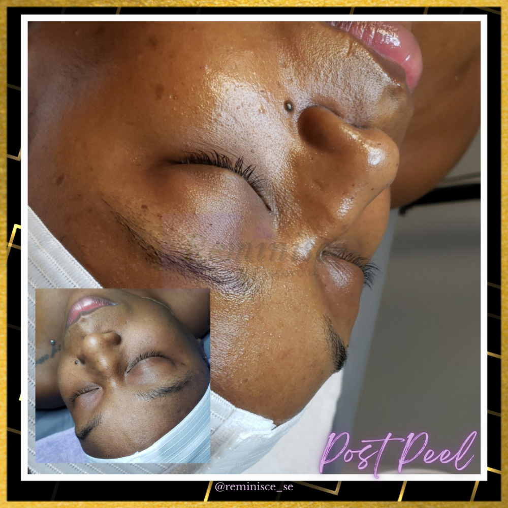 Post Peel Facial