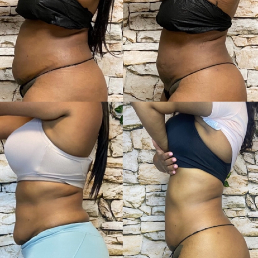 HOT Theapy Bandage at Beauty Body Boss