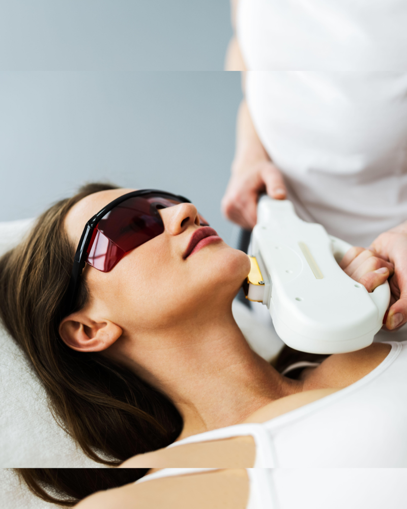 IPL Photofacial